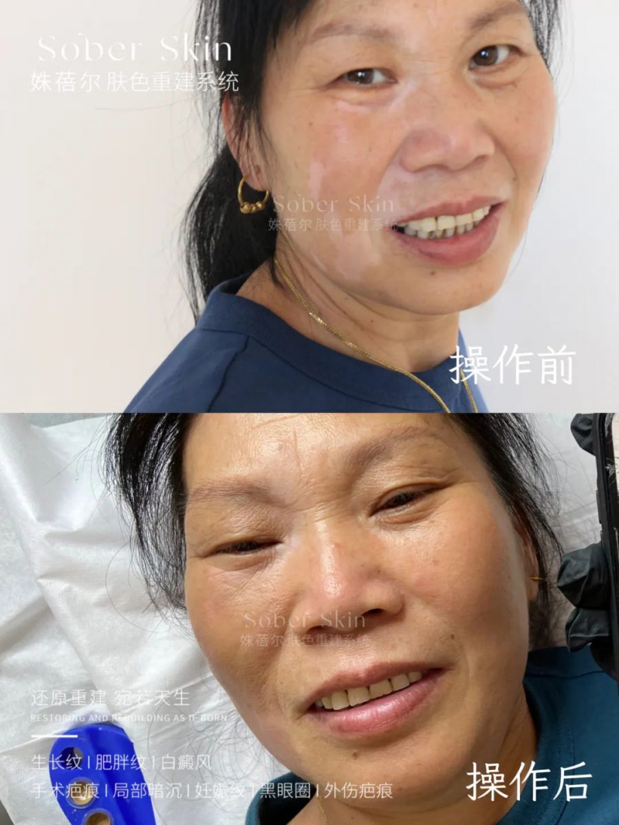 肤色重建斑痕效果